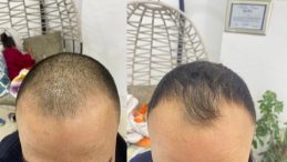 Saç Ekim İşlemleri Afşin’de Özenle Yapılıyor.