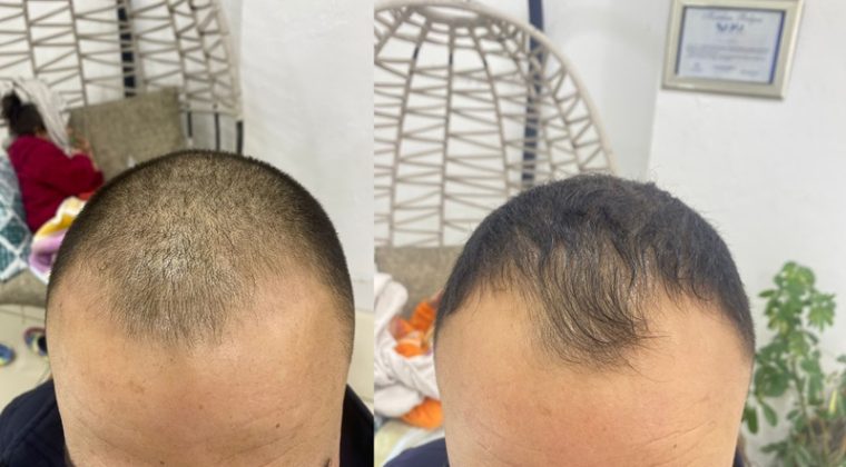 Saç Ekim İşlemleri Afşin’de Özenle Yapılıyor.